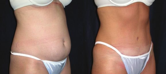 Trbuh prije i poslije liposukcije