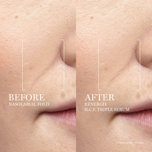 LANCOME_RENERGIE_HCF_TRIPLE_SERUM 2022_BEFORE_AFTER_NASOLABIAL_1X1